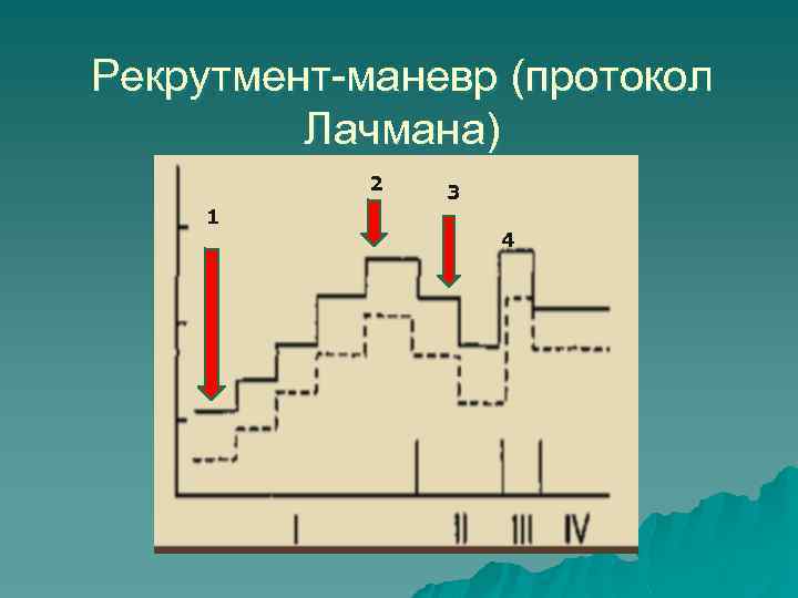 Рекрутмент-маневр (протокол Лачмана) 2 1 3 4 