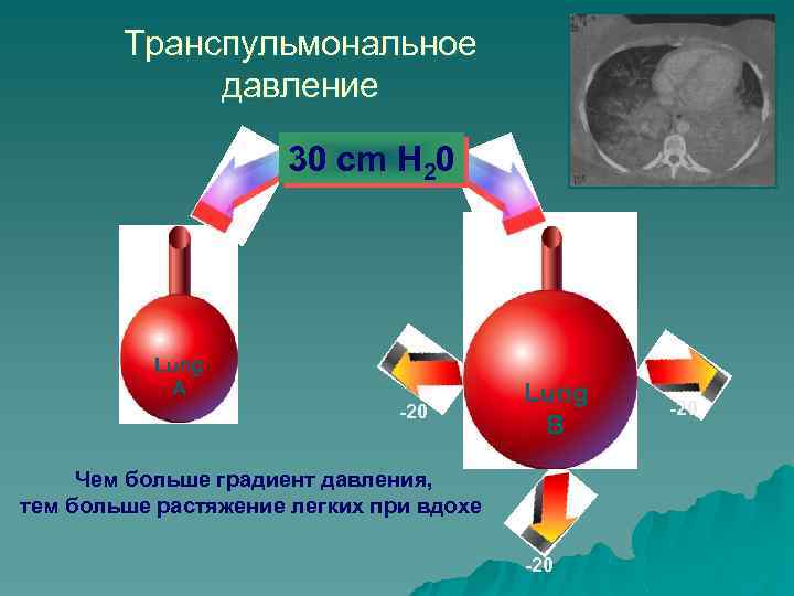 Транспульмональное давление 30 cm H 20 Lung A Lung B Lung A -20 B