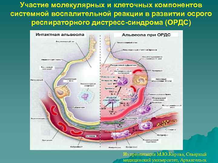 Участие молекулярных и клеточных компонентов системной воспалительной реакции в развитии осрого респираторного дистресс-синдрома (ОРДС)