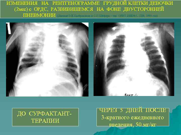 ИЗМЕНЕНИЯ НА РЕНТГЕНОГРАММЕ ГРУДНОЙ КЛЕТКИ ДЕВОЧКИ (2 мес) с ОРДС, РАЗВИВИШЕМСЯ НА ФОНЕ ДВУСТОРОННЕЙ