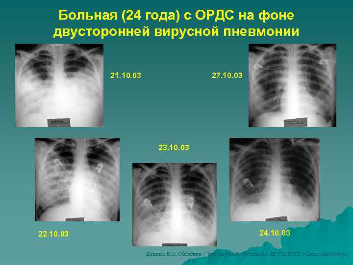 Больная (24 года) с ОРДС на фоне двусторонней вирусной пневмонии 21. 10. 03 27.