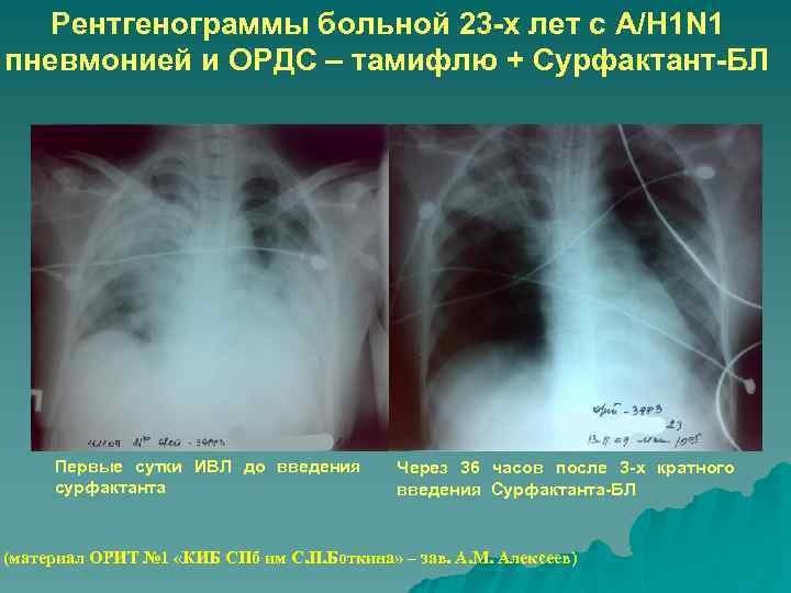 Рентгенограммы больной 23 -х лет с A/H 1 N 1 пневмонией и ОРДС –