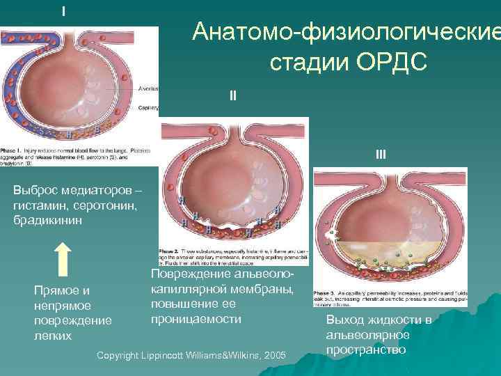 I Анатомо-физиологические стадии ОРДС II III Выброс медиаторов – гистамин, серотонин, брадикинин Прямое и