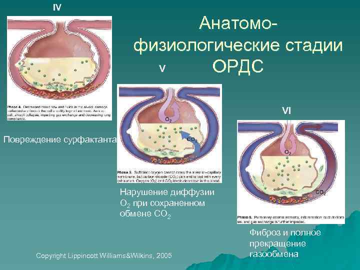 IV Анатомофизиологические стадии V ОРДС VI Повреждение сурфактанта Нарушение диффузии О 2 при сохраненном