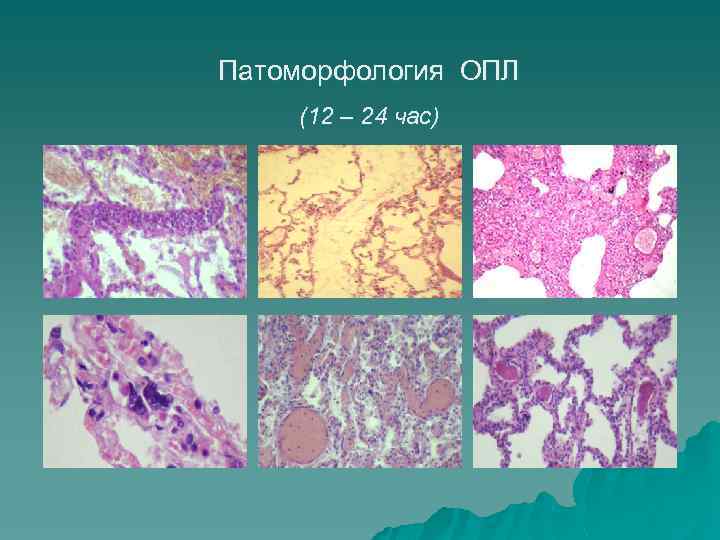 Патоморфология ОПЛ (12 – 24 час) 