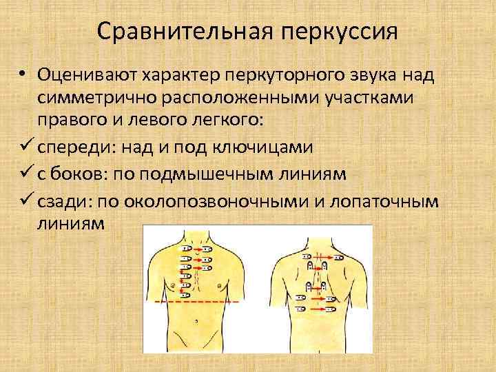 Сравнительная перкуссия • Оценивают характер перкуторного звука над симметрично расположенными участками правого и левого