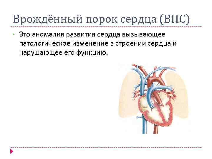 Врождённый порок сердца (ВПС) • Это аномалия развития сердца вызывающее патологическое изменение в строении