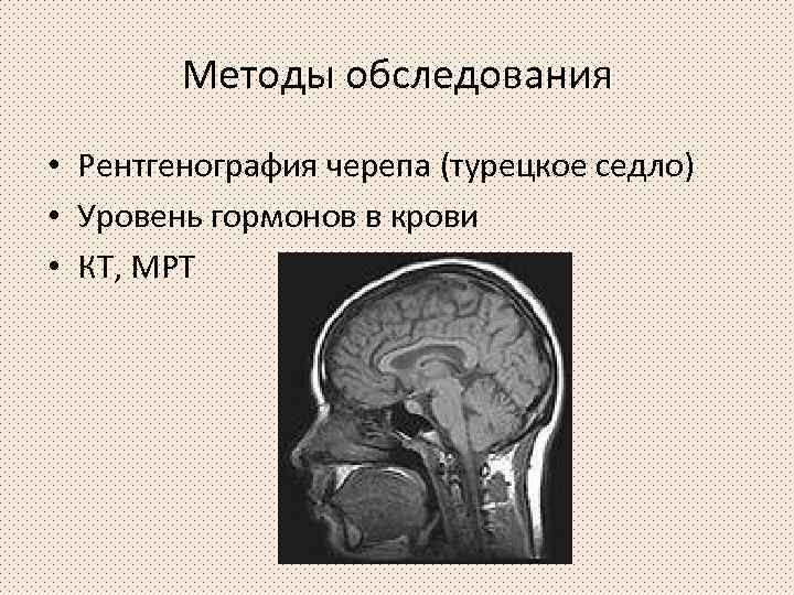 Методы обследования • Рентгенография черепа (турецкое седло) • Уровень гормонов в крови • КТ,