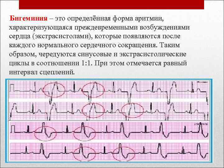 Бигеминия – это определённая форма аритмии, характеризующаяся преждевременными возбуждениями сердца (экстрасистолами), которые появляются после