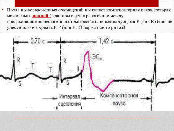  • После несвоевременных сокращений наступает компенсаторная пауза, которая может быть полной (в данном