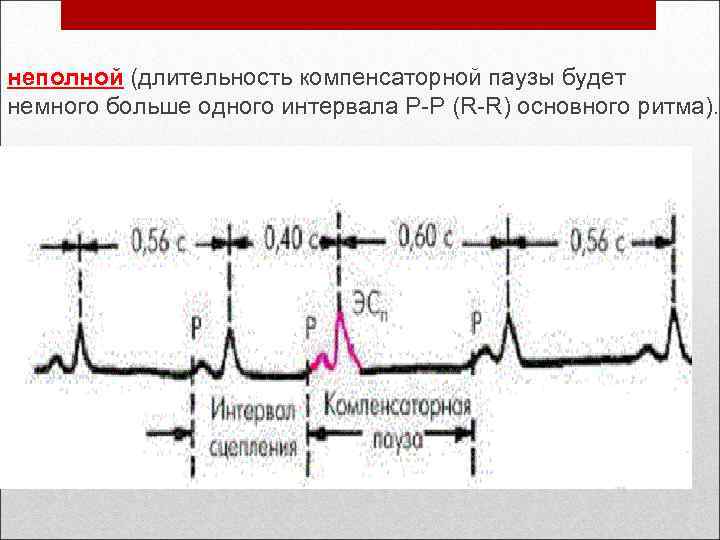 неполной (длительность компенсаторной паузы будет немного больше одного интервала Р-Р (R-R) основного ритма). 