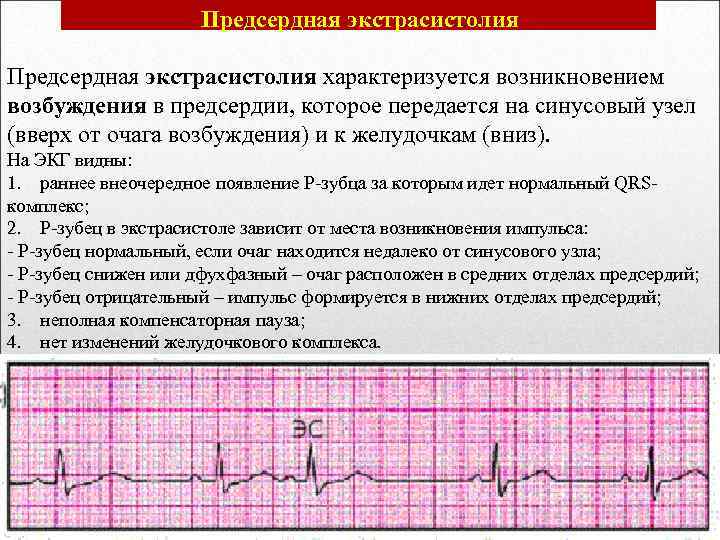  Предсердная экстрасистолия характеризуется возникновением возбуждения в предсердии, которое передается на синусовый узел (вверх