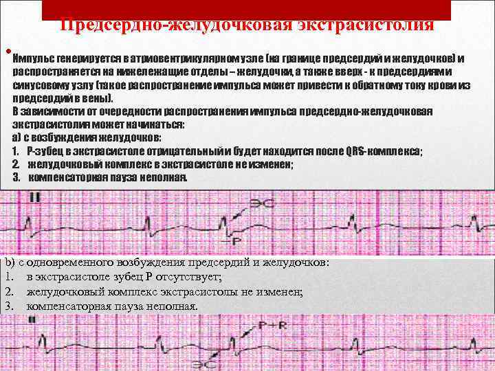 Предсердно-желудочковая экстрасистолия • Импульс генерируется в атриовентрикулярном узле (на границе предсердий и желудочков) и