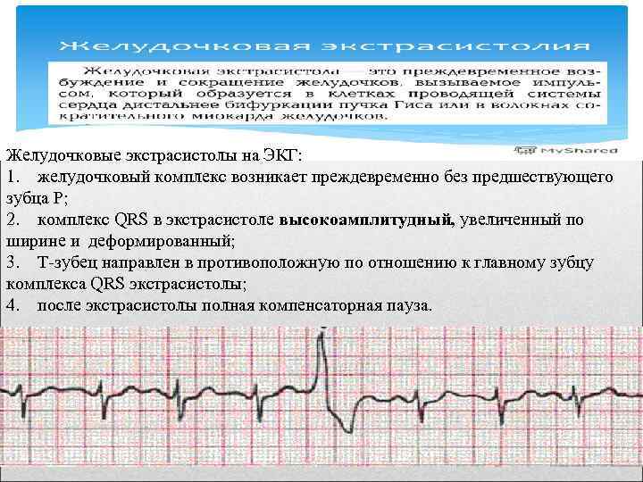 Желудочковые экстрасистолы на ЭКГ: 1. желудочковый комплекс возникает преждевременно без предшествующего зубца Р; 2.