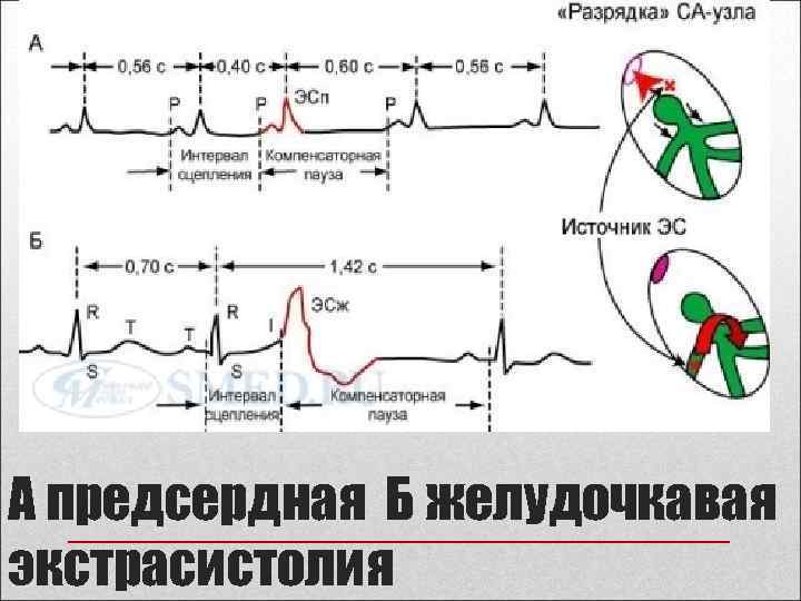 А предсердная Б желудочкавая экстрасистолия 