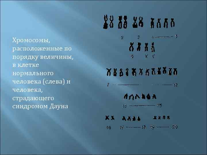 Хромосомы, расположенные по порядку величины, в клетке нормального человека (слева) и человека, страдающего синдромом