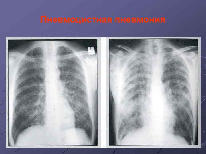 Пневмоцистная пневмония 