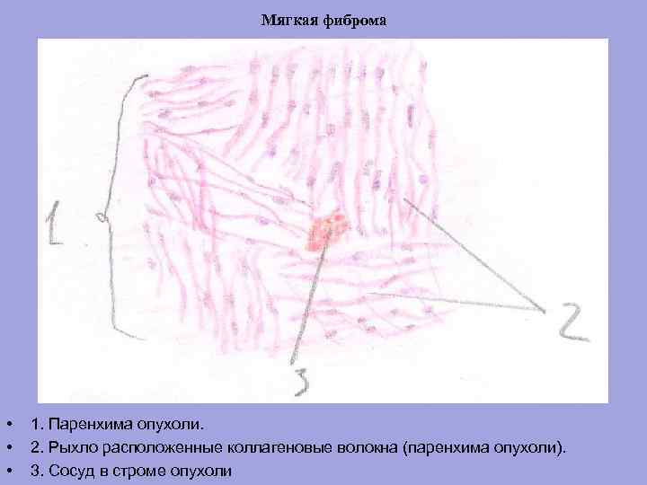 Мягкая фиброма • • • 1. Паренхима опухоли. 2. Рыхло расположенные коллагеновые волокна (паренхима