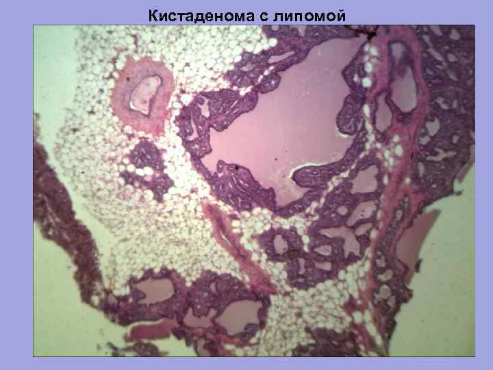 Кистаденома с липомой 