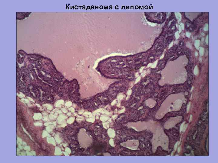 Кистаденома с липомой 