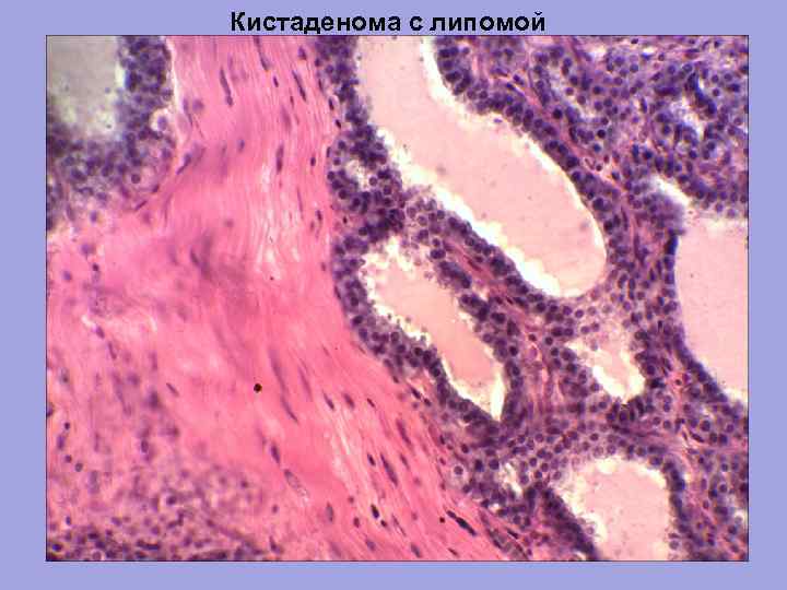 Кистаденома с липомой 