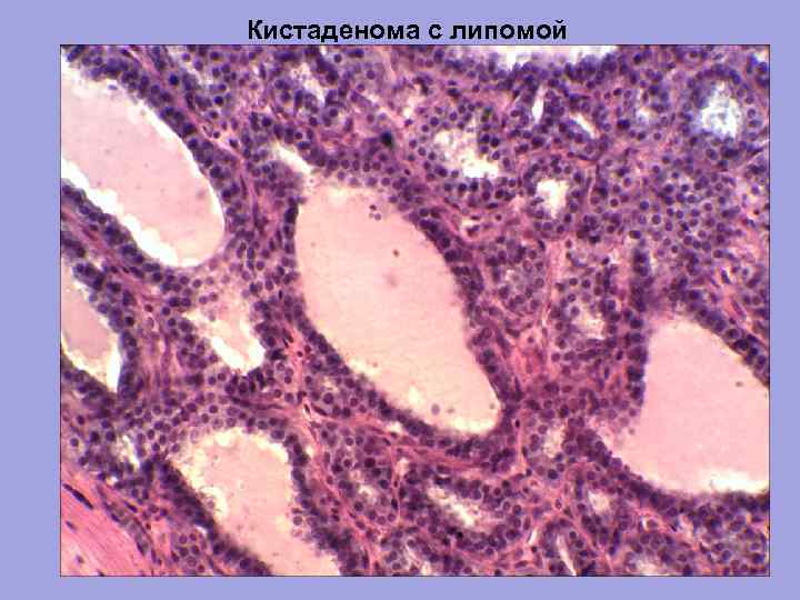 Кистаденома с липомой 