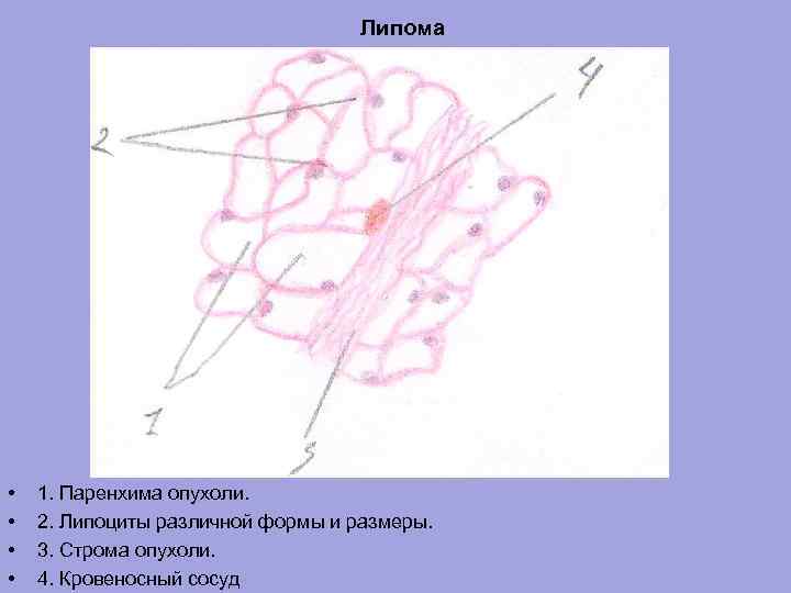 Липома • • 1. Паренхима опухоли. 2. Липоциты различной формы и размеры. 3. Строма