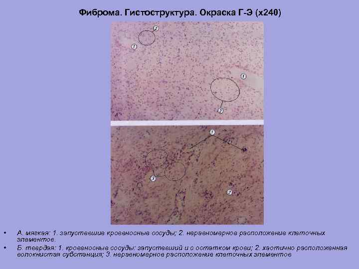 Фиброма. Гистоструктура. Окраска Г-Э (х240) • • А. мягкая: 1. запустевшие кровеносные сосуды; 2.