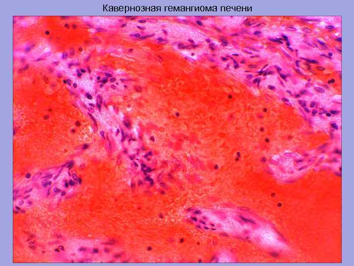 Кавернозная гемангиома печени 