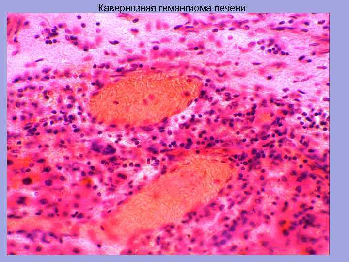 Кавернозная гемангиома печени 