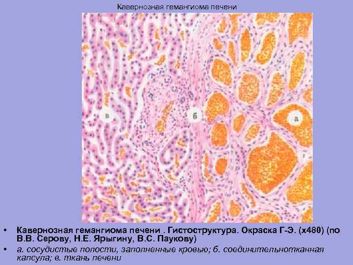 Кавернозная гемангиома печени • • Кавернозная гемангиома печени. Гистоструктура. Окраска Г-Э. (х480) (по В.