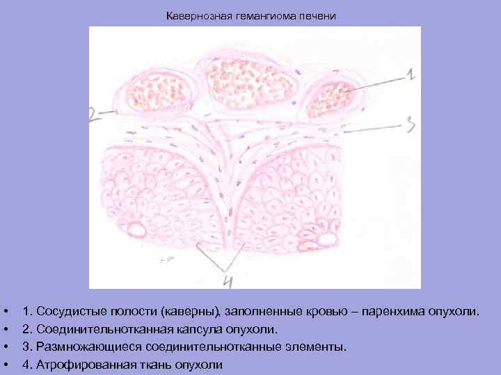 Кавернозная гемангиома печени • • 1. Сосудистые полости (каверны), заполненные кровью – паренхима опухоли.