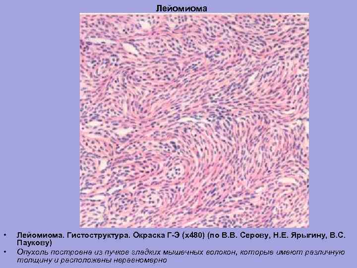 Лейомиома • • Лейомиома. Гистоструктура. Окраска Г-Э (х480) (по В. В. Серову, Н. Е.