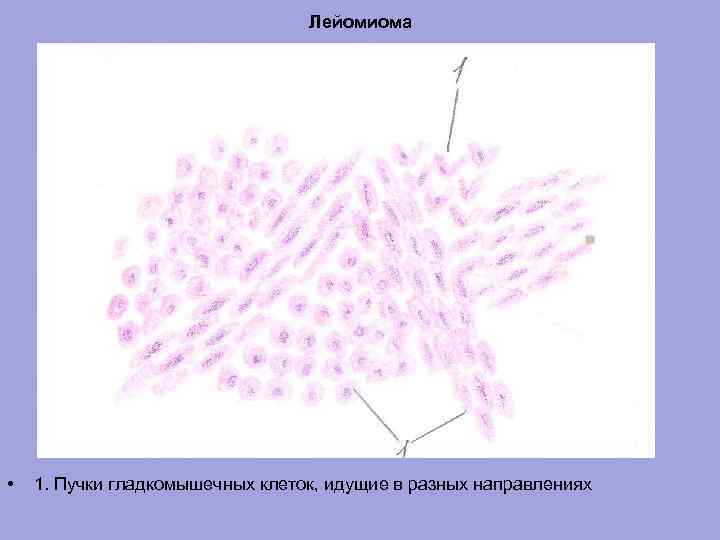 Лейомиома • 1. Пучки гладкомышечных клеток, идущие в разных направлениях 