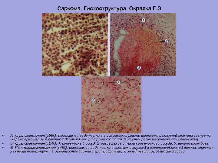 Саркома. Гистоструктура. Окраска Г-Э • • • А. круглоклеточная (х960): паренхима представлена в основном