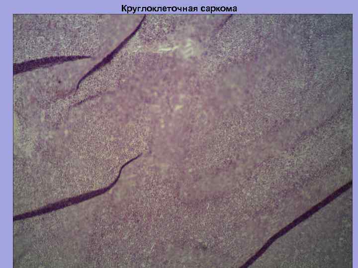 Круглоклеточная саркома 