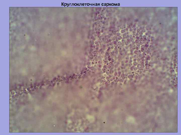 Круглоклеточная саркома 