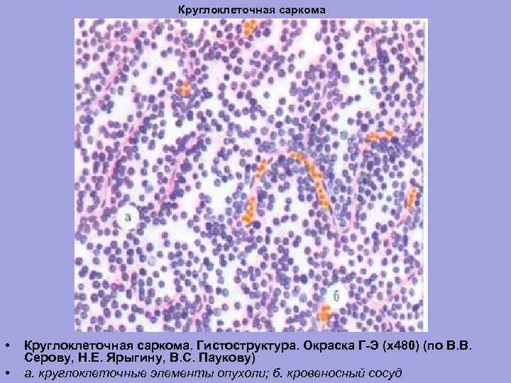 Круглоклеточная саркома • • Круглоклеточная саркома. Гистоструктура. Окраска Г-Э (х480) (по В. В. Серову,