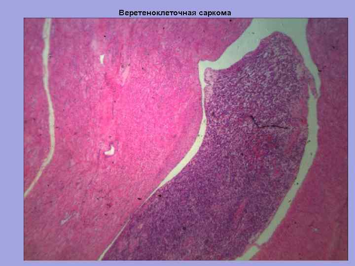 Веретеноклеточная саркома 