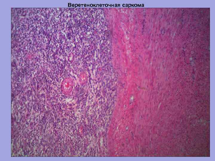 Веретеноклеточная саркома 