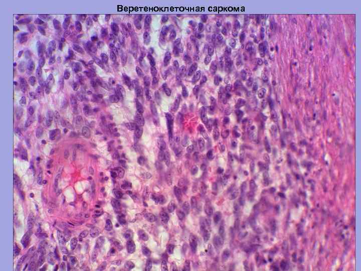 Веретеноклеточная саркома 