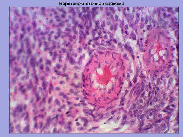 Веретеноклеточная саркома 