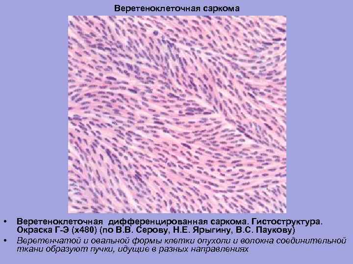 Веретеноклеточная саркома • • Веретеноклеточная дифференцированная саркома. Гистоструктура. Окраска Г-Э (х480) (по В. В.