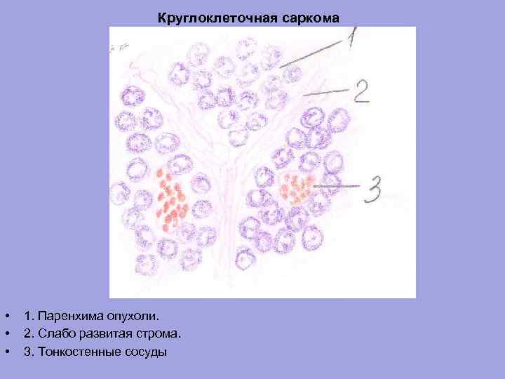 Круглоклеточная саркома • • • 1. Паренхима опухоли. 2. Слабо развитая строма. 3. Тонкостенные