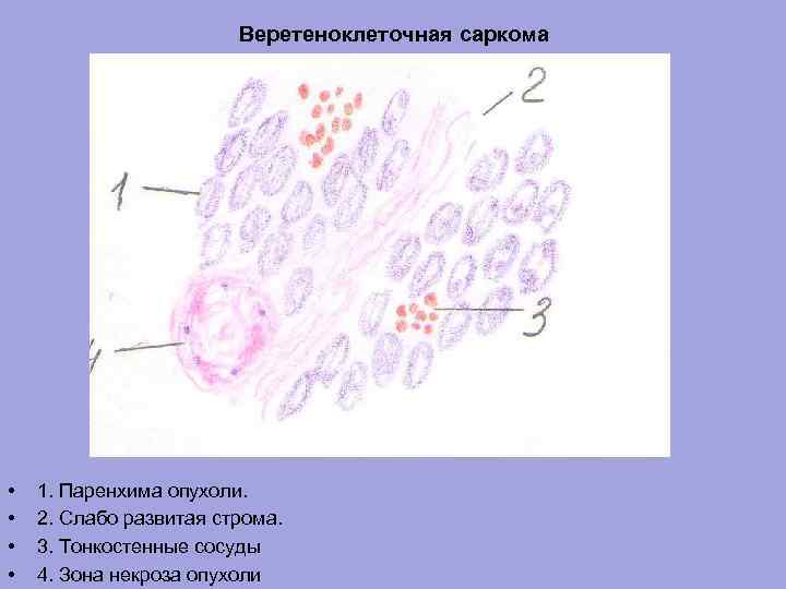 Веретеноклеточная саркома • • 1. Паренхима опухоли. 2. Слабо развитая строма. 3. Тонкостенные сосуды