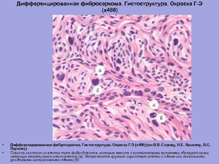 Дифференцированная фибросаркома. Гистоструктура. Окраска Г-Э (х480) • • Дифференцированная фибросаркома. Гистоструктура. Окраска Г-Э (х480)