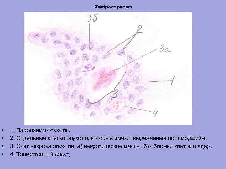 Фибросаркома • • 1. Паренхима опухоли. 2. Отдельные клетки опухоли, которые имеют выраженный полиморфизм.