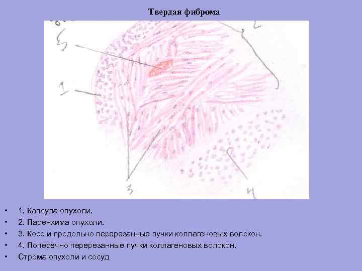 Твердая фиброма • • • 1. Капсула опухоли. 2. Паренхима опухоли. 3. Косо и