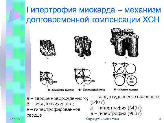Гипертрофия миокарда – механизм долговременной компенсации ХСН Feb-18 а – сердце новорожденного; б –