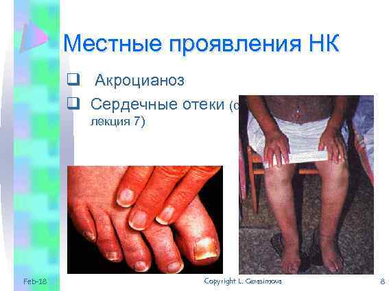 Местные проявления НК q Акроцианоз q Сердечные отеки (см. лекция 7) Feb-18 Copyright L.